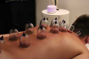 CUPPING-TERAPIJA_2